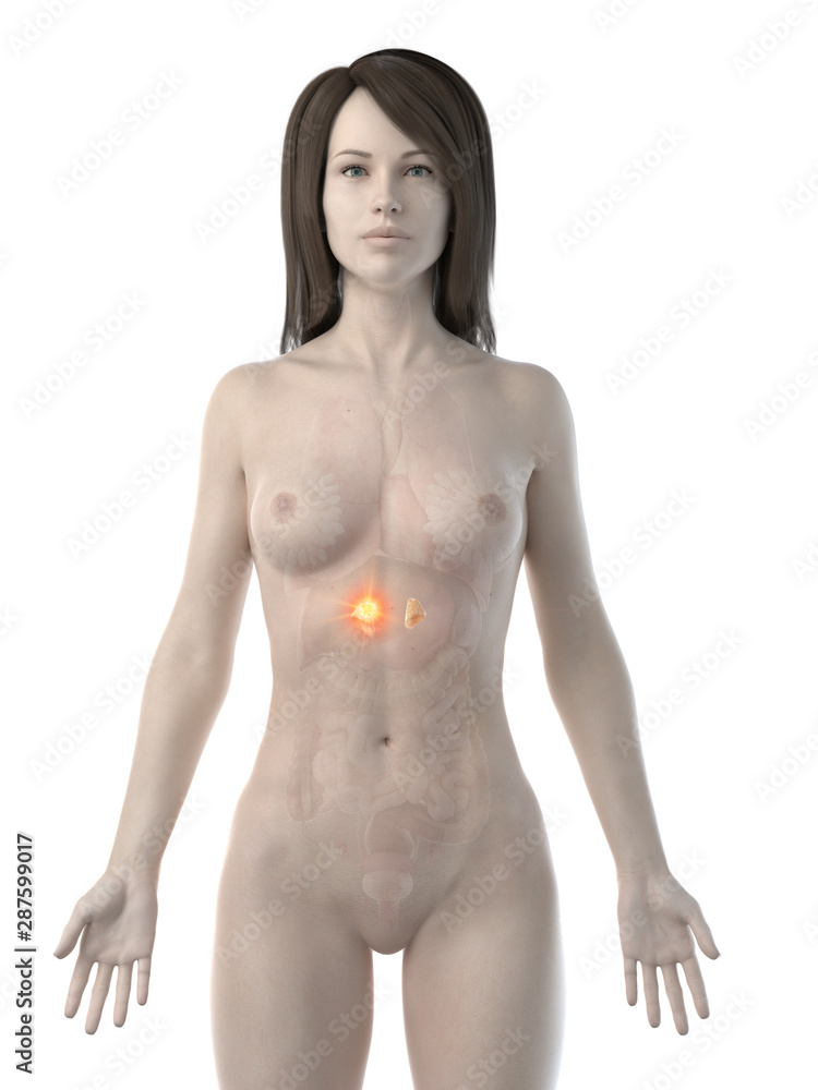 Fototapeta premium 3d rendered medically accurate illustration of a womans adrenal glands cancer