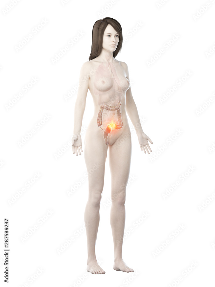 3d rendered medically accurate illustration of a womans large intestine cancer 3d rendered medically accurate illustration of a womans large intestine cancer