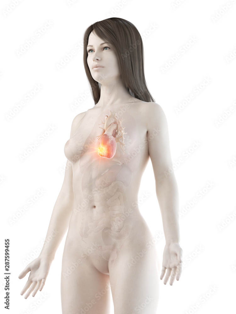 Naklejka premium 3d rendered medically accurate illustration of a womans heart cancer