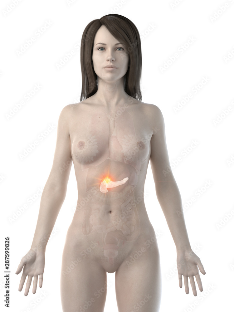 Naklejka premium 3d rendered medically accurate illustration of a womans pancreas cancer