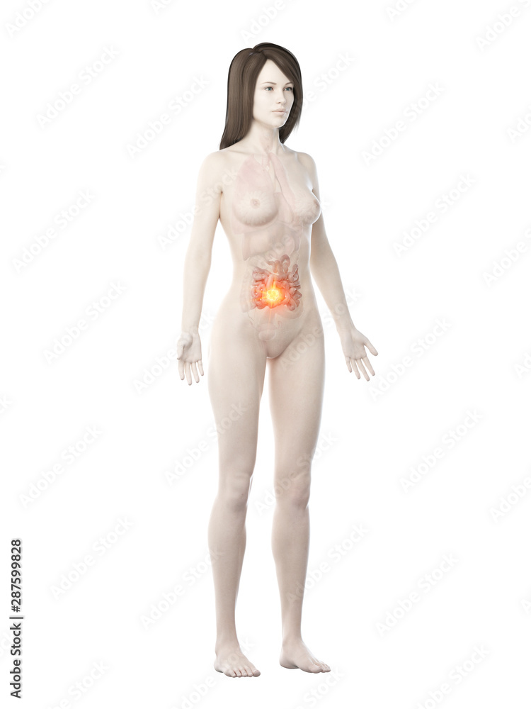 Fototapeta premium 3d rendered medically accurate illustration of a womans small intestine cancer