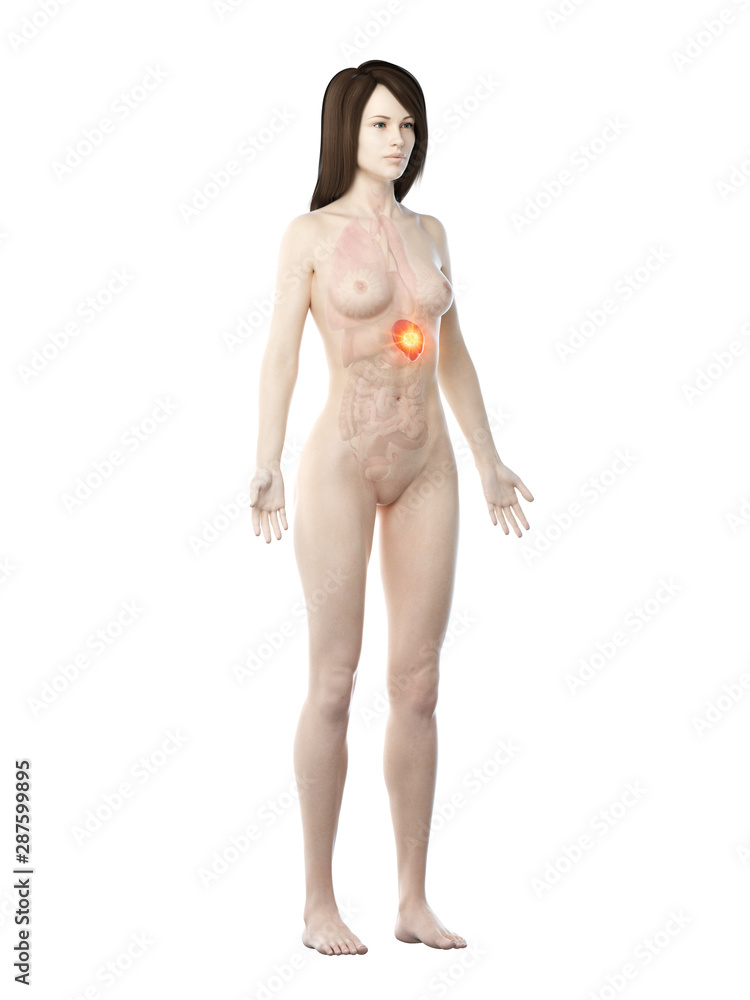 Fototapeta premium 3d rendered medically accurate illustration of a womans spleen cancer
