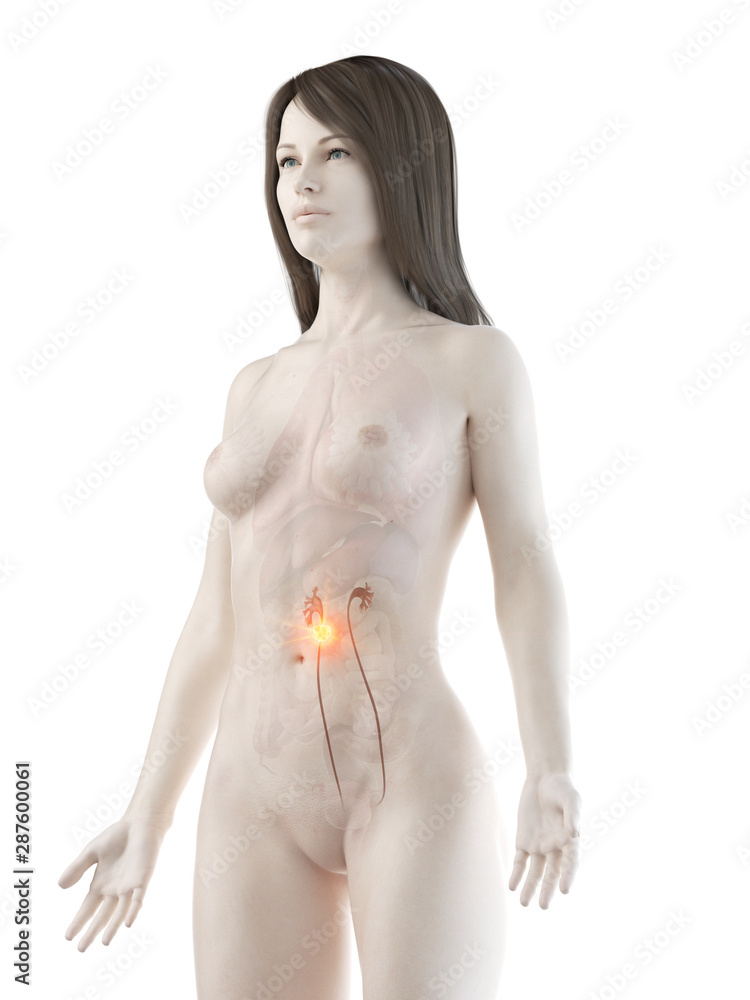 Fototapeta premium 3d rendered medically accurate illustration of a womans ureter cancer