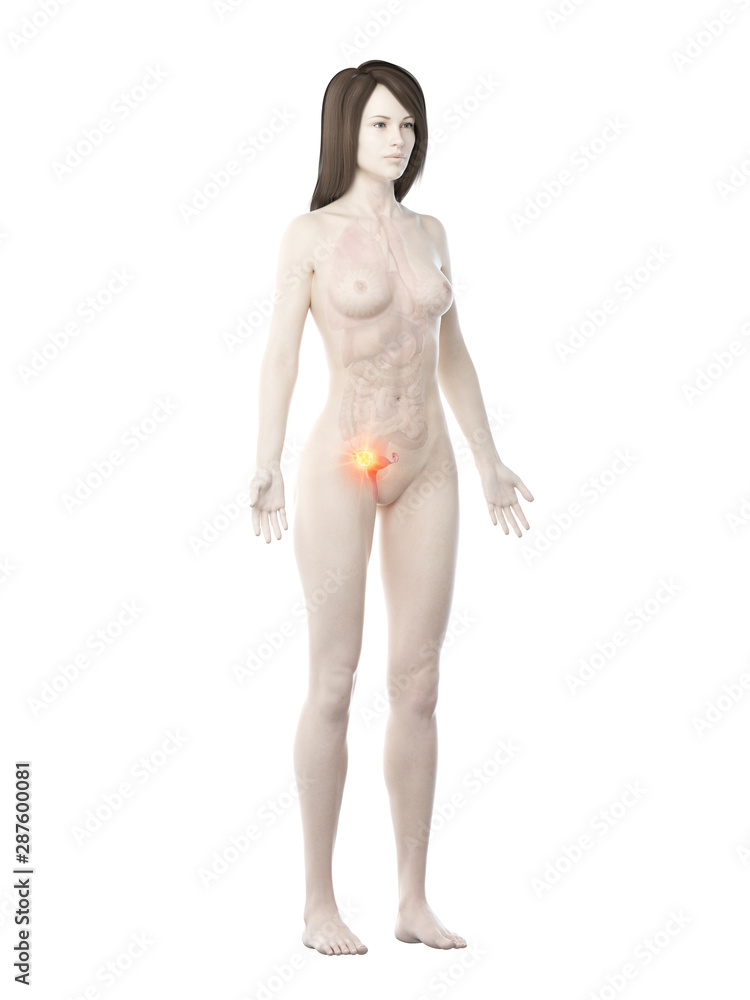 3d rendered medically accurate illustration of a womans uterus cancer 3d rendered medically accurate illustration of a womans uterus cancer