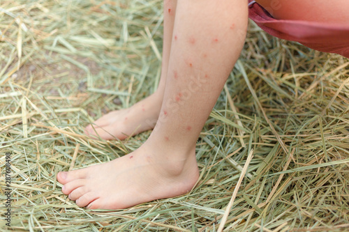 A shot of mosquitoes and bugs bite and scar spot on child legs