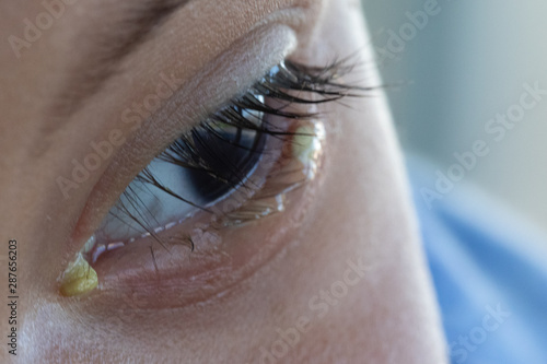 A closeup view on the eye of a toddler with a bacterial infection, causing a yellow pus discharge and watery eyeballs. Common childhood sickness.