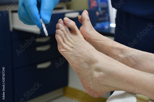 Podiatrist Foot Fungus Bunion