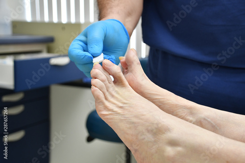 Podiatrist Foot Fungus Bunion