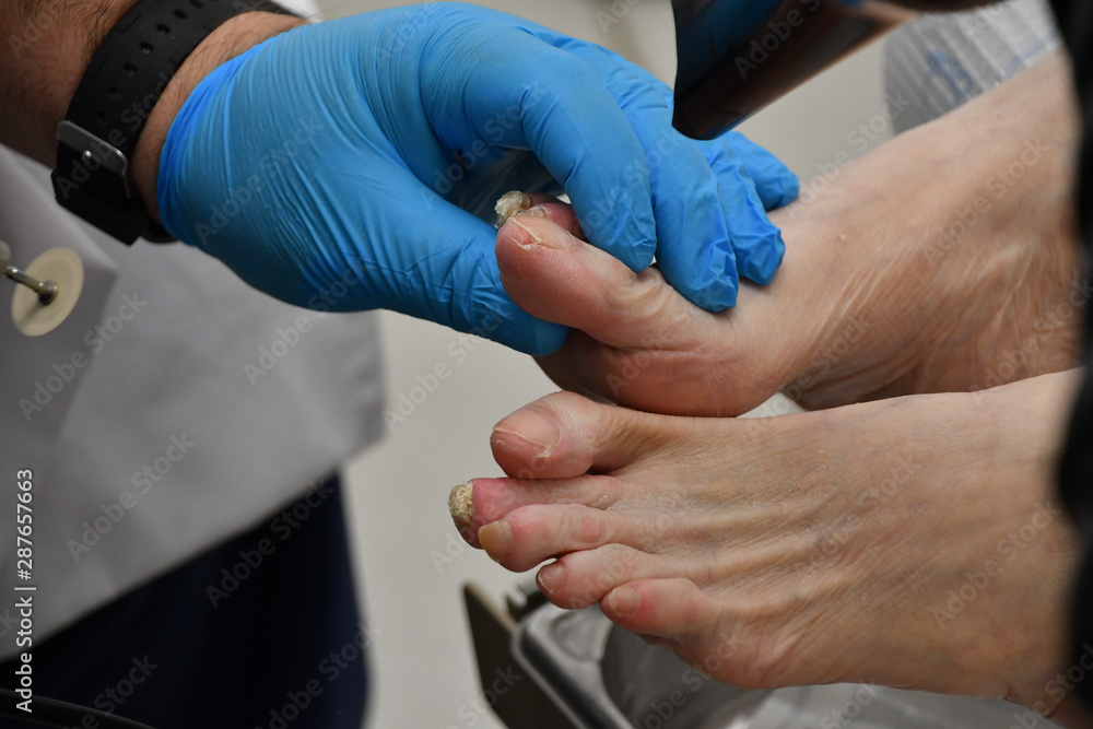 Podiatry Foot Fungus Bunion Podiatry Foot Fungus Bunion