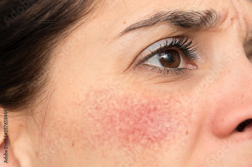 Fototapeta Naklejka Na Ścianę i Meble -  A frowning caucasian woman is seen close up and from the side, upset with a severe case of rosacea, causing red blotchy cheeks, resulting in depression and anxiety.