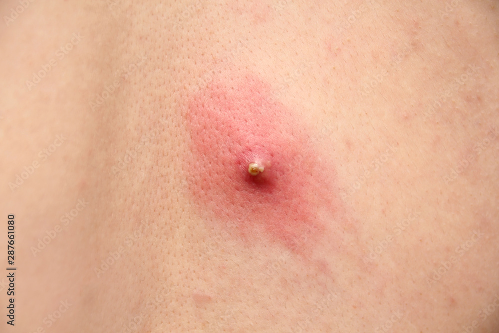 large inflamed pimple on human skin, medical concept, close-up, copy space