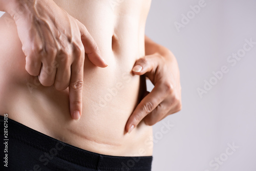 Fototapeta Closeup of woman showing on her belly dark scar from a cesarean section