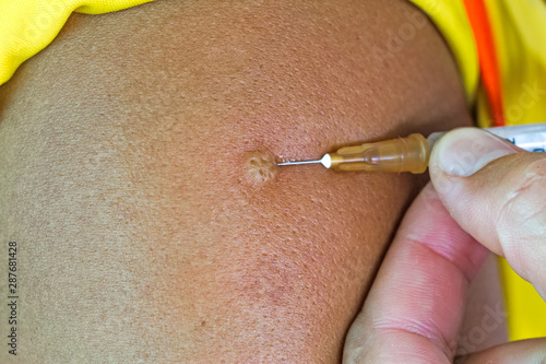 Hand of doctor inject vaccine solution in intradermal