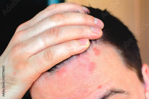 Man shows red psoriasis on his forehead