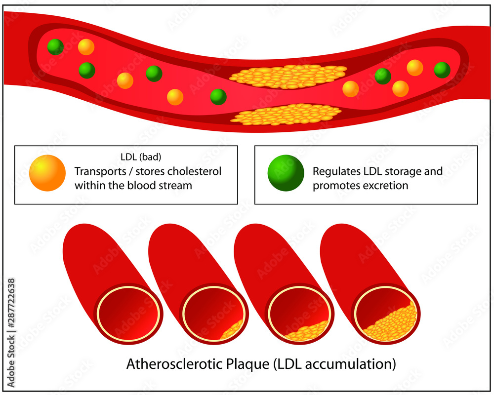 Role of good and bad lipids and levels of atherosclerotic plaque in blood vessel medical vector infographics Role of good and bad lipids and levels of atherosclerotic plaque in blood vessel medical vector infographics