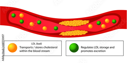 Atherosclerotic plaque in blood vessel and good and bad lipids vector infographics