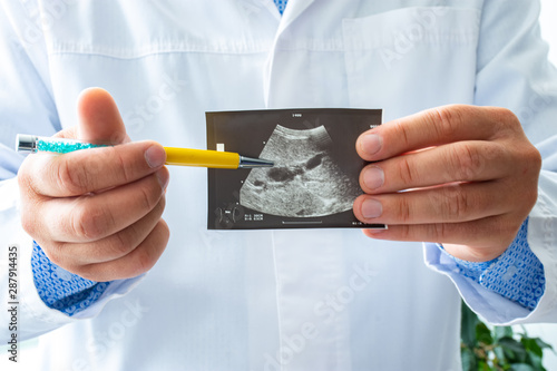 Doctor holds before itself and shows patient printed picture with ultrasound examination of gallbladder, pointing with a pen on gallbladder and its pathology. Concept photo ultrasonic  biliary system photo