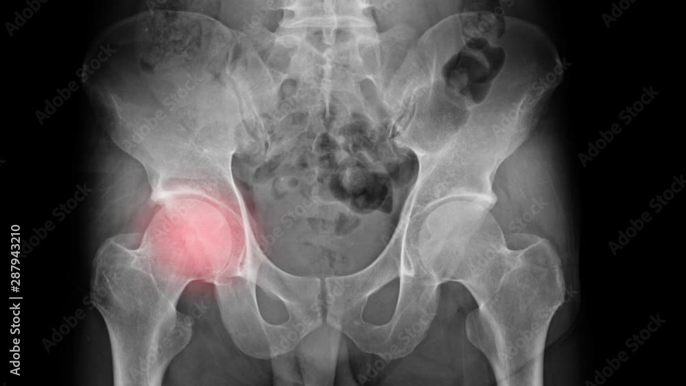 hip degenerative change xray footage with red hight light, hip