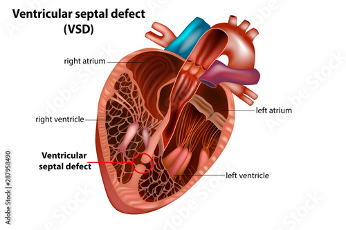 Ventricular septal defect (VSD).Congenital heart defect photo