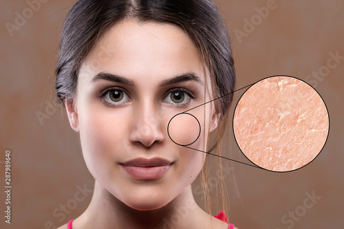 A young brunette woman is seen close up, a magnified circle shows macro skin details, dry and flaky in need of face creams and dermatologist skincare specialist