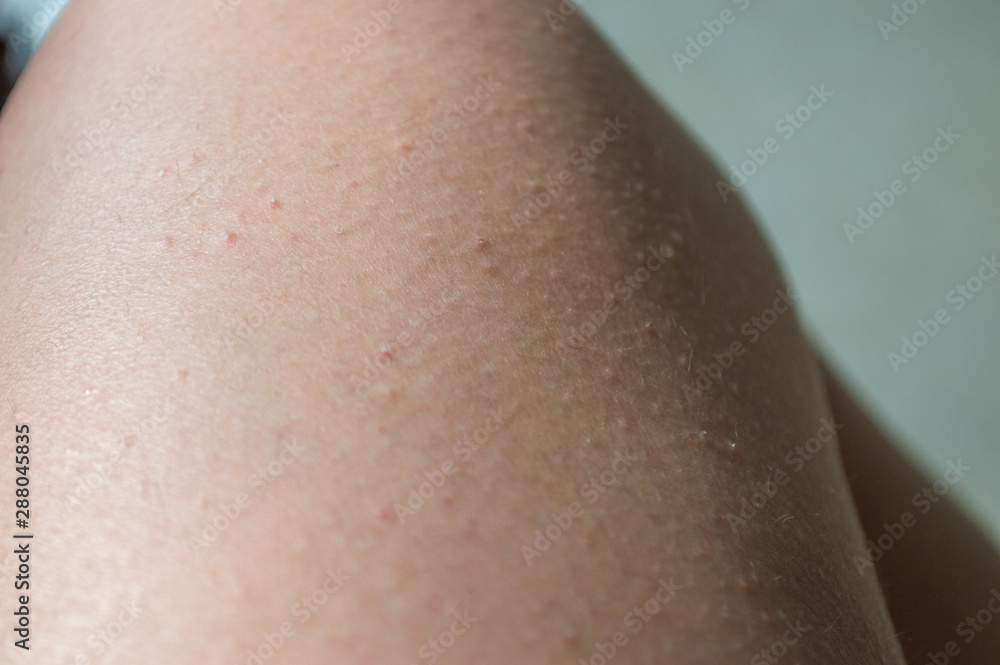 Caucasian white leg with small red points, named folliculitis; personal care concept Caucasian white leg with small red points, named folliculitis; personal care concept