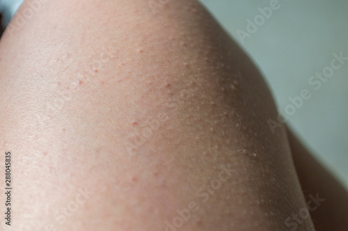 Caucasian white leg with small red points, named folliculitis; personal care concept