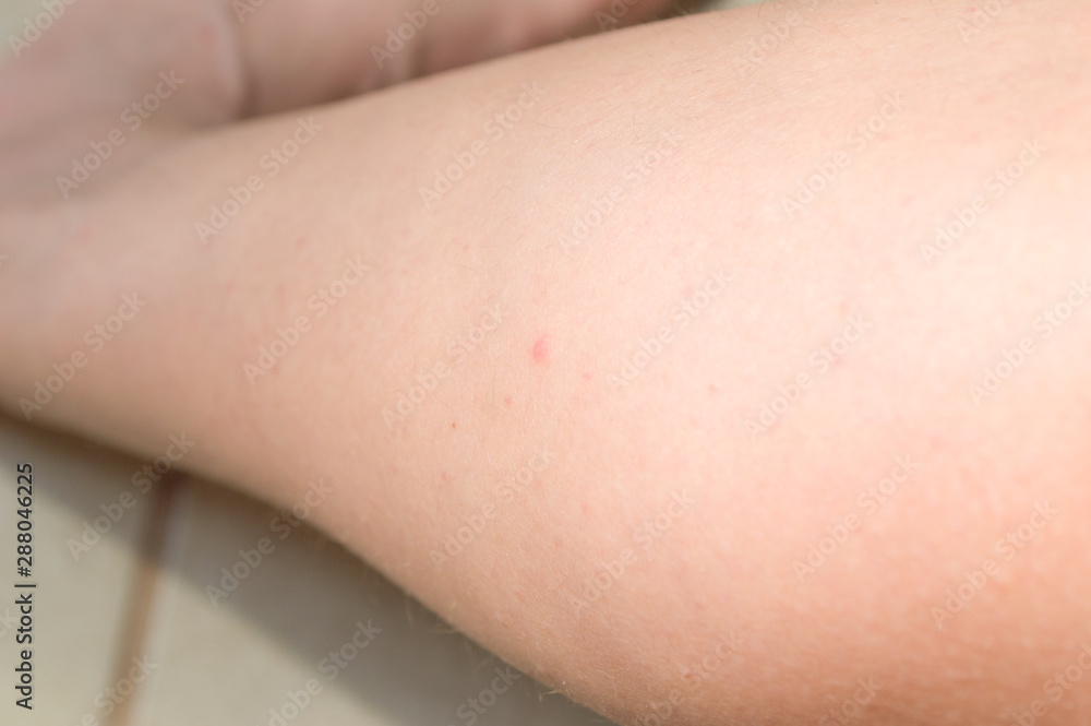 Caucasian white leg with small red points, named folliculitis; personal care concept Caucasian white leg with small red points, named folliculitis; personal care concept