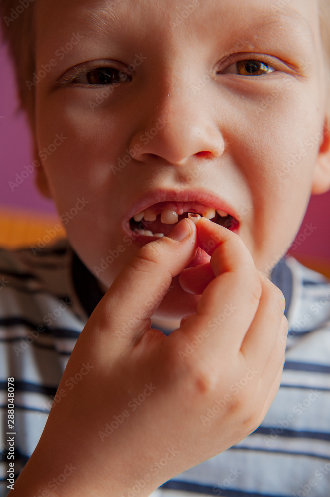 Cute baby shows dropped baby tooth. Boy smiles with toothless mouth. Striped home pajamas, proton purple background Cute baby shows dropped baby tooth. Boy smiles with toothless mouth. Striped home pajamas, proton purple background