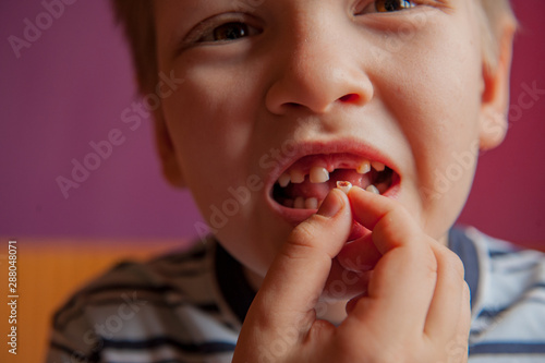 Cute baby shows dropped baby tooth. Boy smiles with toothless mouth. Striped home pajamas, proton purple background