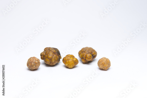 Gallstones,multiple cholesterol stone in gall bladder with cholecystitis .