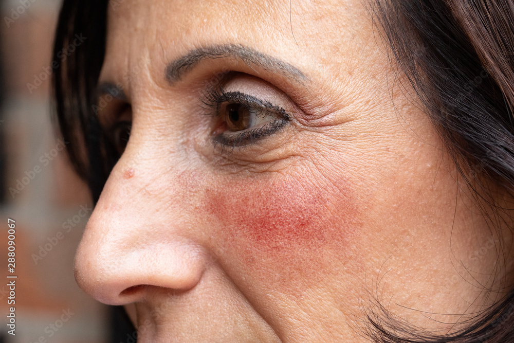 Obraz premium A close up and side view on the attractive face of an older mature woman in her fifties, suffering from rosy red cheeks, symptomatic of rosacea, with copy space.