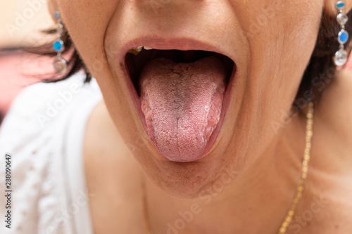 A closeup view on the open mouth of a caucasian lady, sticking her tongue out to reveal a white film, symptomatic of oral candidiasis (thrush), a common complaint in adult women.