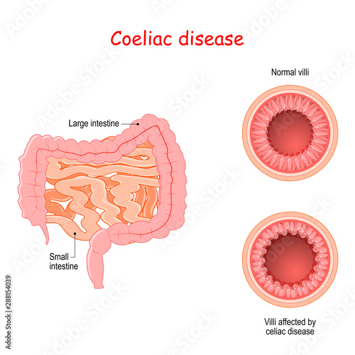 Coeliac disease. Cross section of small bowel with normal villi and villi affected by celiac disease