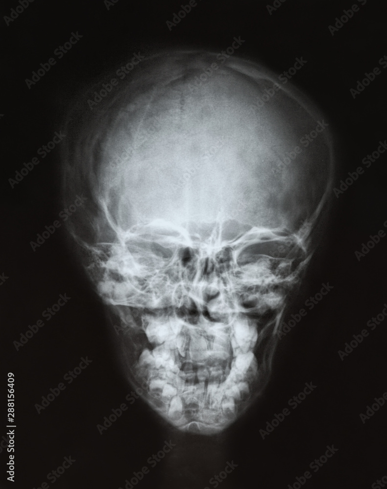 X-ray film of the child's skull. X-ray film of the child's skull.