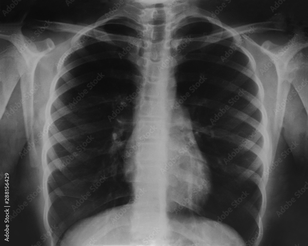 X-ray film of the teenager's thorax. X-ray film of the teenager's thorax.