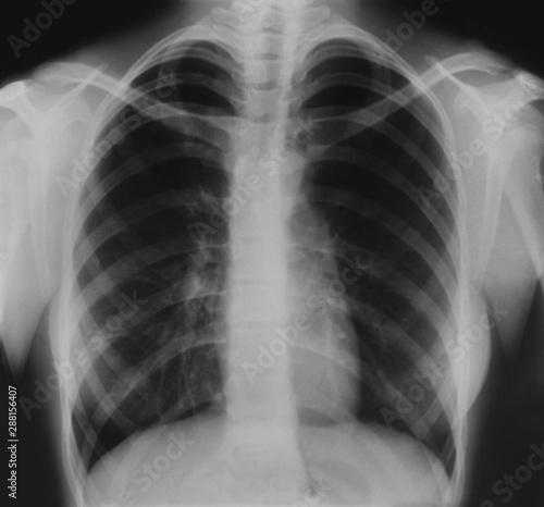 X-ray film of the teenager's thorax.