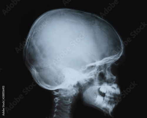 X-ray film of the head, child's skull.