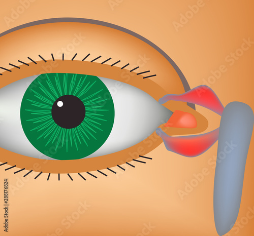 Canaliculitis. Inflammation of lacrimal canals. The structure of the eye. Infographics. Vector illustration.