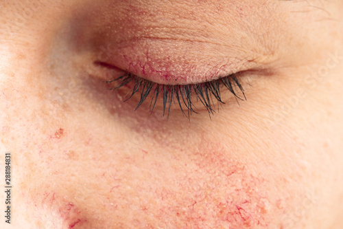 An extreme closeup view on the closed eye of a thirty year old girl, showing blood vessels at the surface of the skin around the upper cheek and eyelid, symptomatic of rosacea.