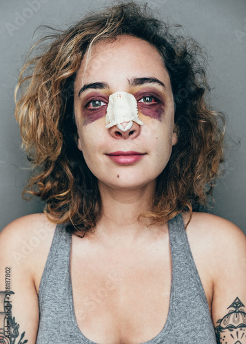 portrait of a woman with rhinoplasty and black eye photo