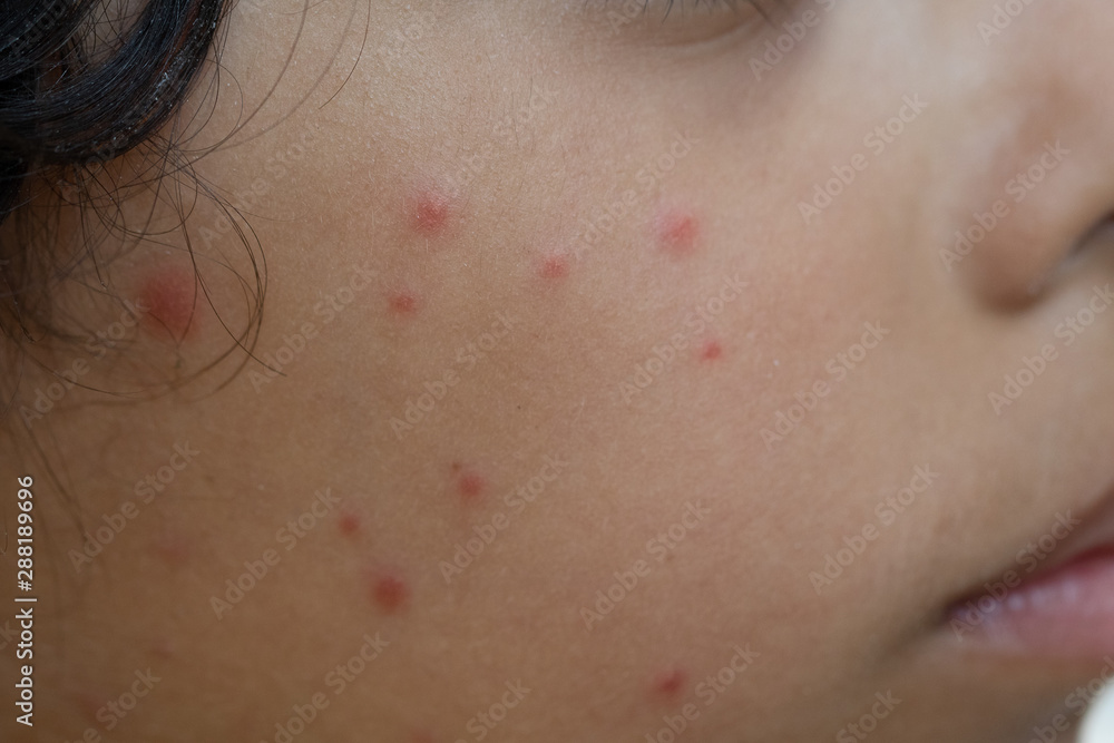 A closeup and side view on the face of a young child, sick and unwell with chickenpox (varicella zoster virus) a highly contagious disease common in youngsters. A closeup and side view on the face of a young child, sick and unwell with chickenpox (varicella zoster virus) a highly contagious disease common in youngsters.