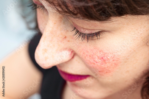 A closeup and high angle view of a pretty woman suffering from persistent facial redness (erythema) and visible blood vessels, all symptoms of rosacea, with copy space. photo