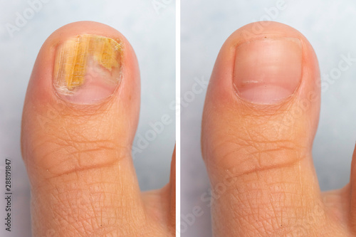 Before and after topical antifungal treatment is seen in the big toe of a person suffering from Onychomycosis, a fungal infection causing yellowing of the toenail. photo