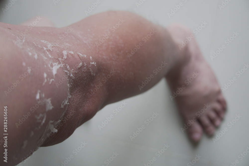 Fototapeta premium The human leg that show the sun burn skin