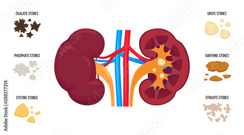 Kidneys stones types. Flat vector illustration: oxalate stones, phosphate, cystine, urate, xanthine, struvite stones. Internal human organ anatomy. Realistic detailed graphic. Kidney stone disease.