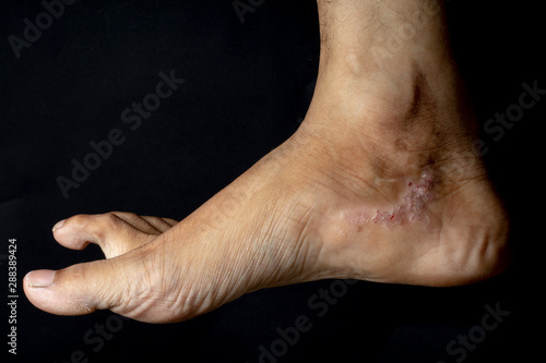 atopic dermatitis also known as eczema on a man's foot with a back background