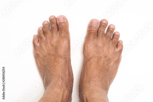 Asian man foot brown and dry skin © littlestocker