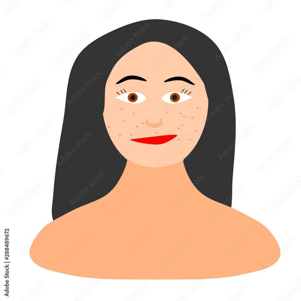 Sad girl with pimples on the face, cheeks and forehead. Teenager's skin problems. Sad girl with pimples on the face, cheeks and forehead. Teenager's skin problems.
