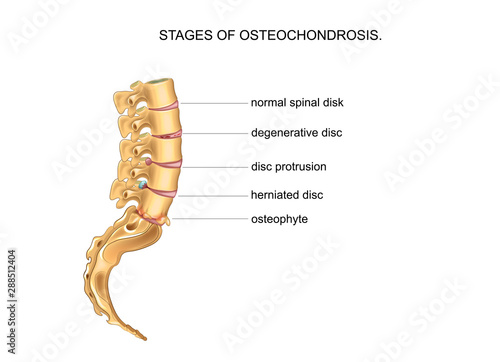 stages of degenerative disc disease
