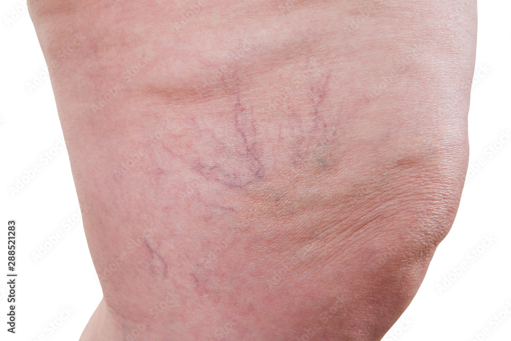 Fototapeta premium Varicose veins closeup, fat female legs isolated on white background
